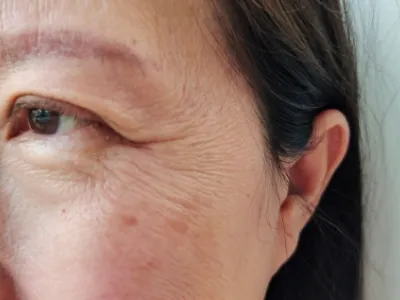 加齢による腱膜の変化