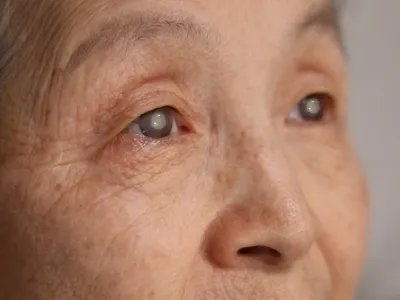 眼内手術の既往