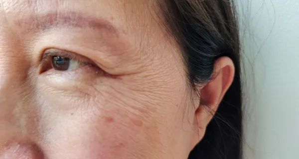 加齢による腱膜の変化