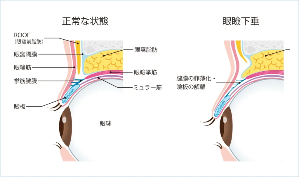 正常な状態と眼瞼下垂