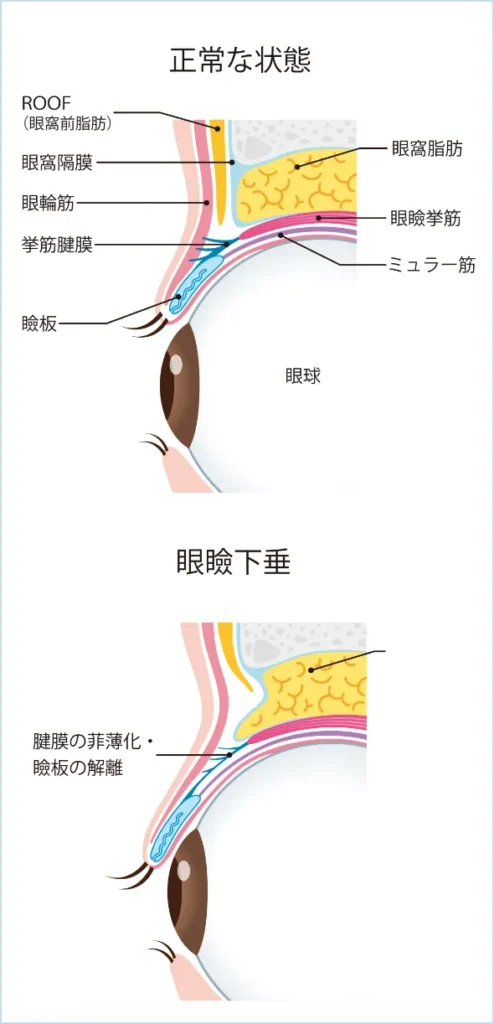 正常な状態と眼瞼下垂