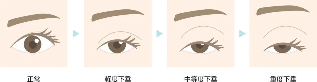 眼瞼下垂の状態