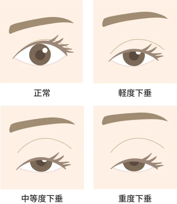眼瞼下垂の状態