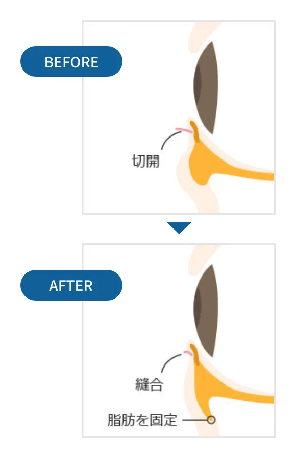 裏ハムラ法_before_after