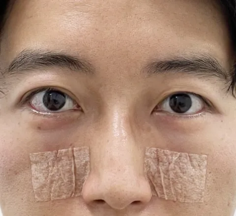 裏ハムラ法_3日目