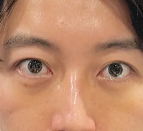 裏ハムラ法_5日目