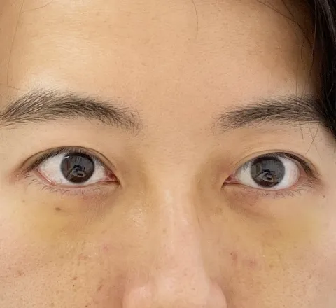 裏ハムラ法_1週間