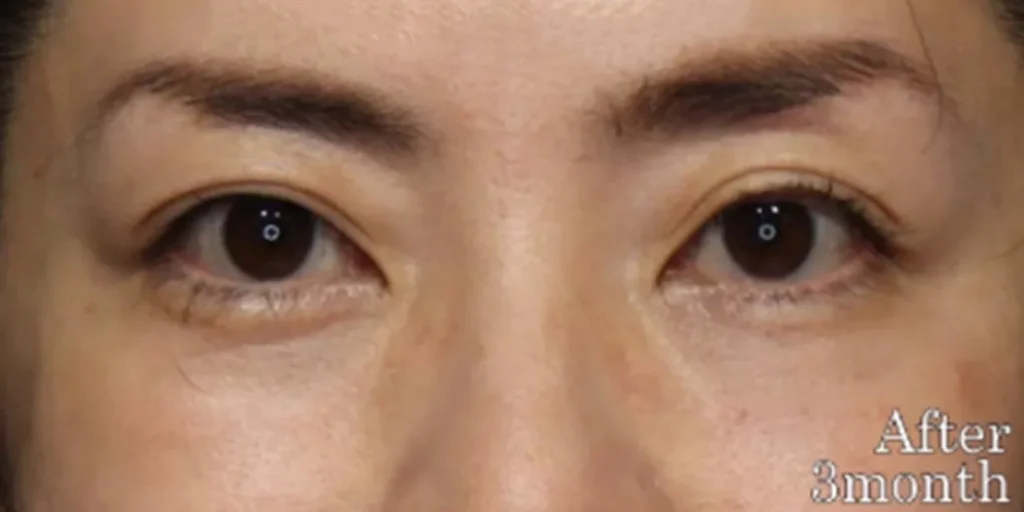 裏ハムラ法after