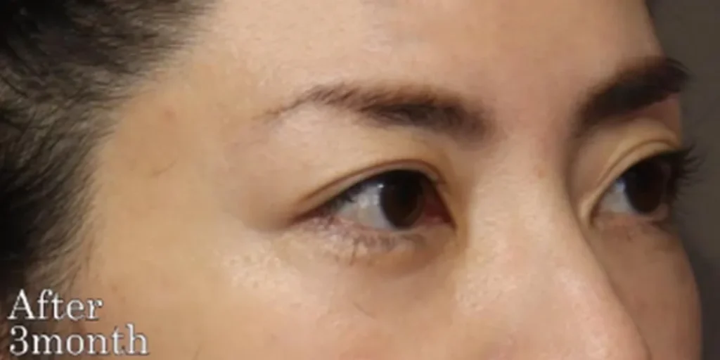 裏ハムラ法after