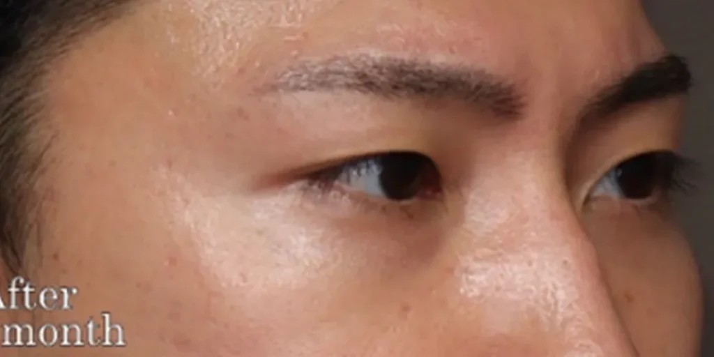 裏ハムラ法after