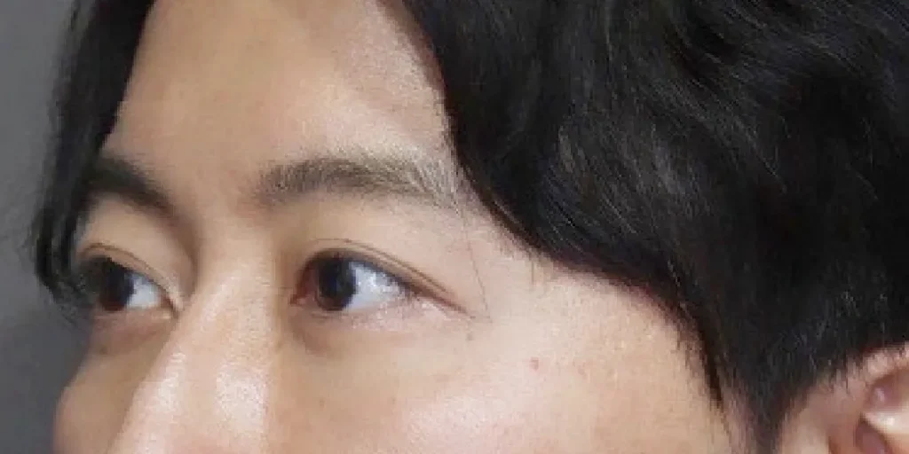 裏ハムラ法after