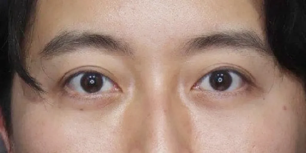 裏ハムラ法after