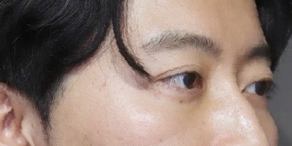 裏ハムラ法after