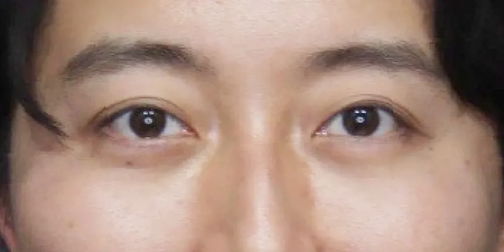 裏ハムラ法after