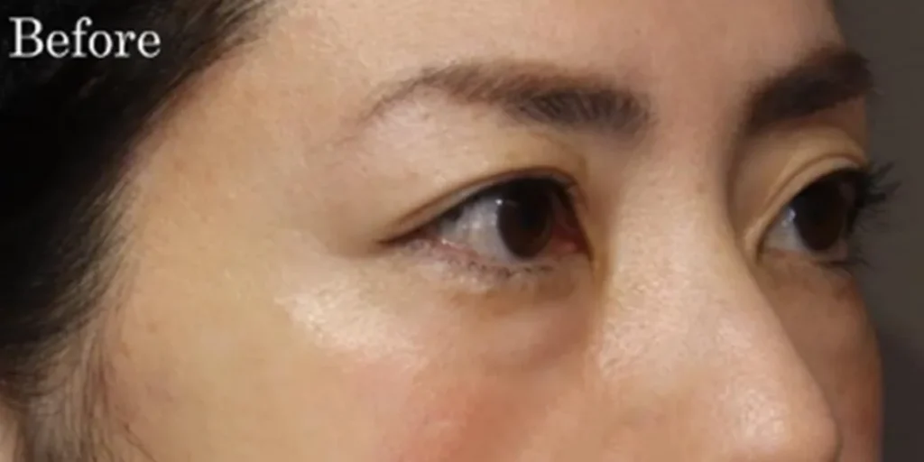 裏ハムラ法before