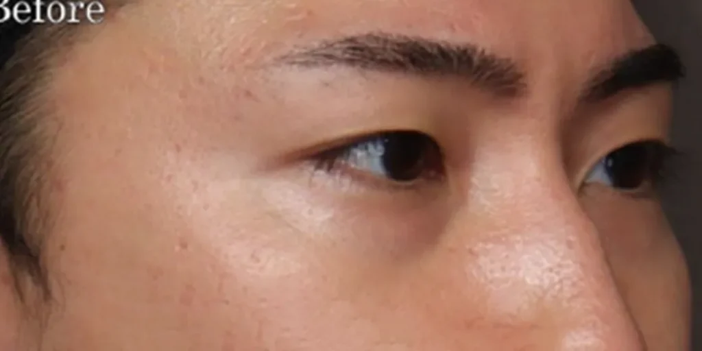 裏ハムラ法before