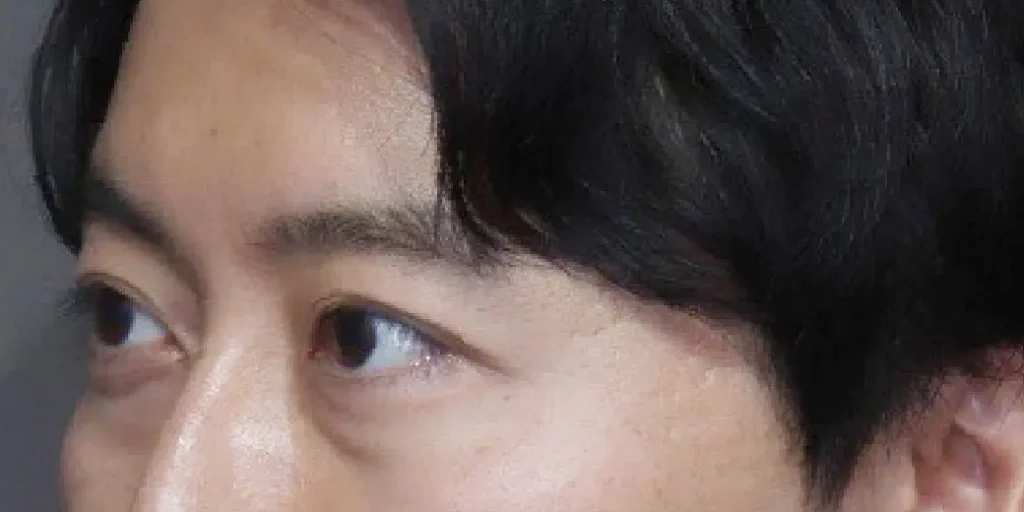 裏ハムラ法before