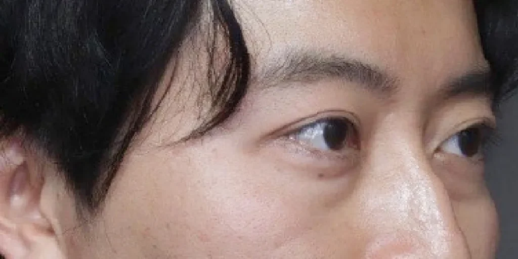 裏ハムラ法before