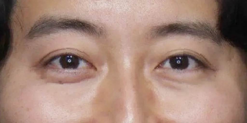 裏ハムラ法before