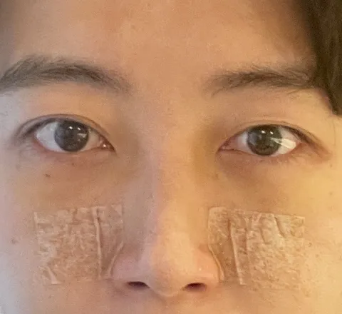 裏ハムラ法_翌日