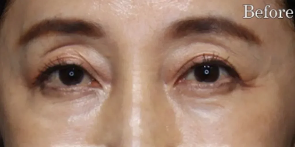 表ハムラ法before