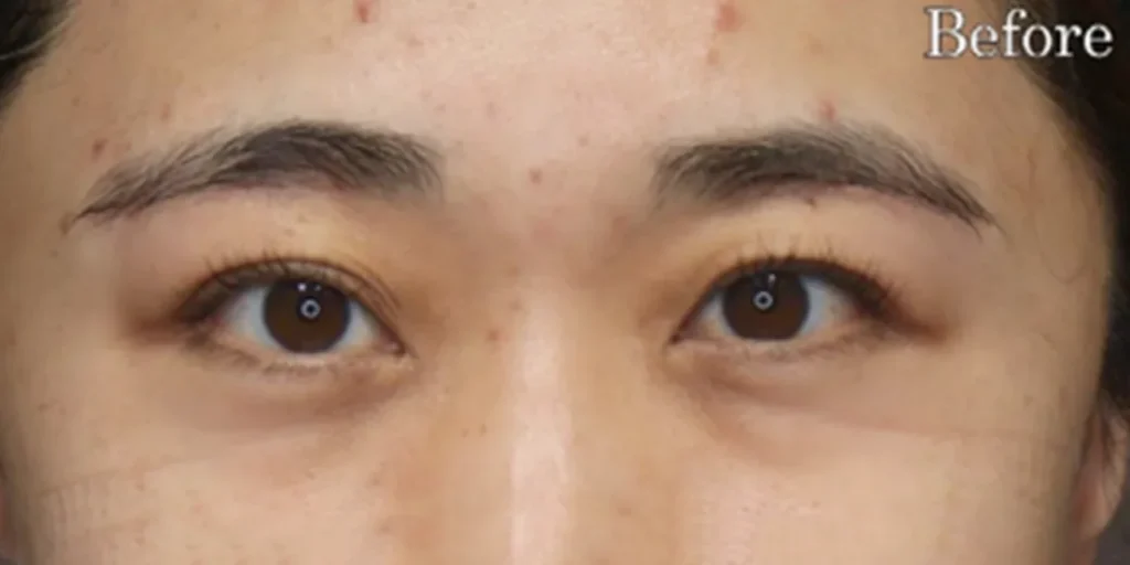 表ハムラ法before