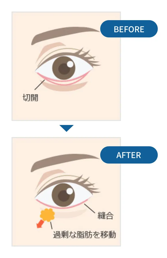 表ハムラ法_before_after