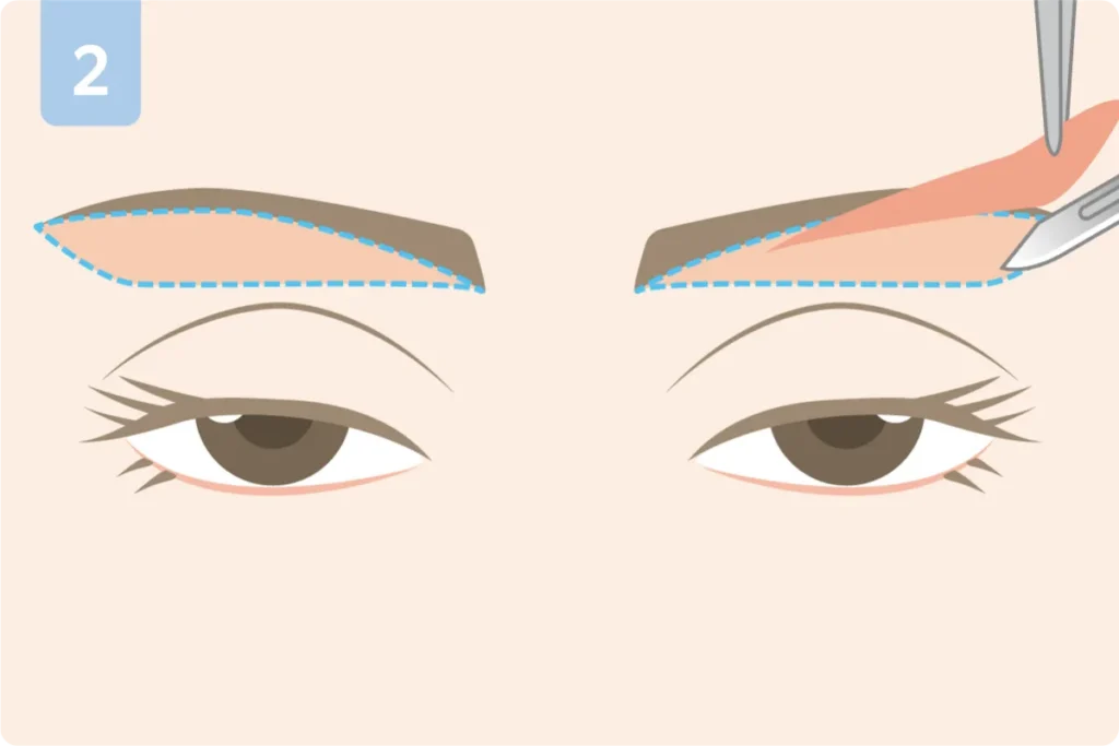 眉下切開術02