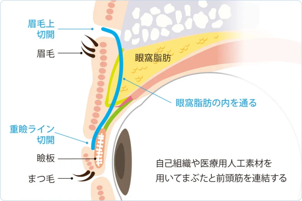 前頭筋つり上げ術